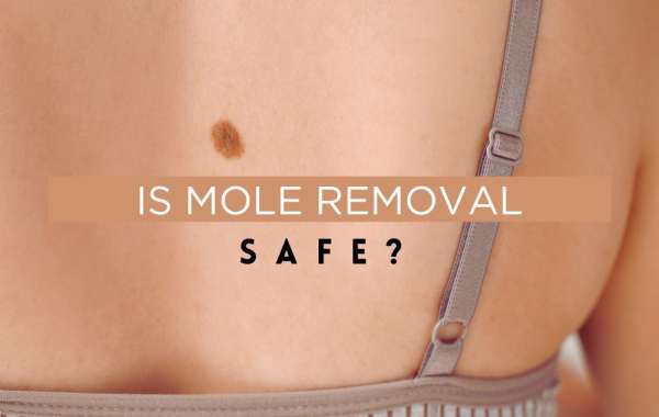 Is Mole Removal Safe?